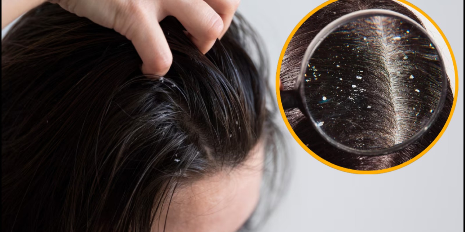 ठंड आते ही सिर में बढ़ गई है खुजली की समस्या, ये 5 रुपए की चीज रूसी Dandruff का कर देगी पक्का इलाज