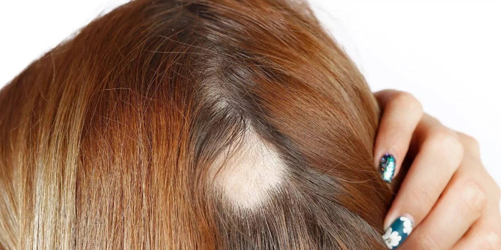 Alopecia Cases On Rise Post Covid; Expert Lists Causes And Treatment Options