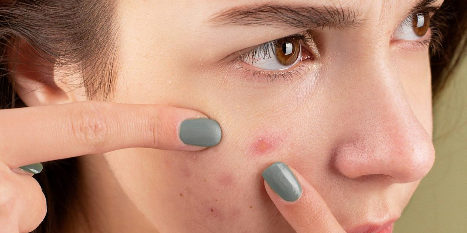 Acne Problem: ব্রনর সমস্যায় ভুগছেন শীতেও, ঘরোয়া উপায়েই দূর হবে দাগছোপ, জ্বালা-যন্ত্রণা