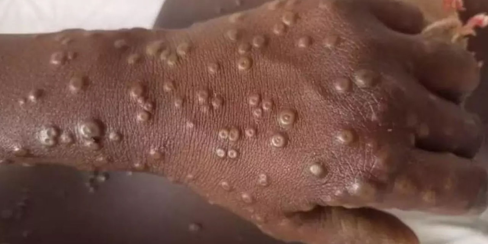 Monkeypox: వామ్మో.. రెండో కేసు నిర్ధారణ..! వేగంగా వ్యాపిస్తున్న మహమ్మారి.. వైద్యుల హెచ్చరిక