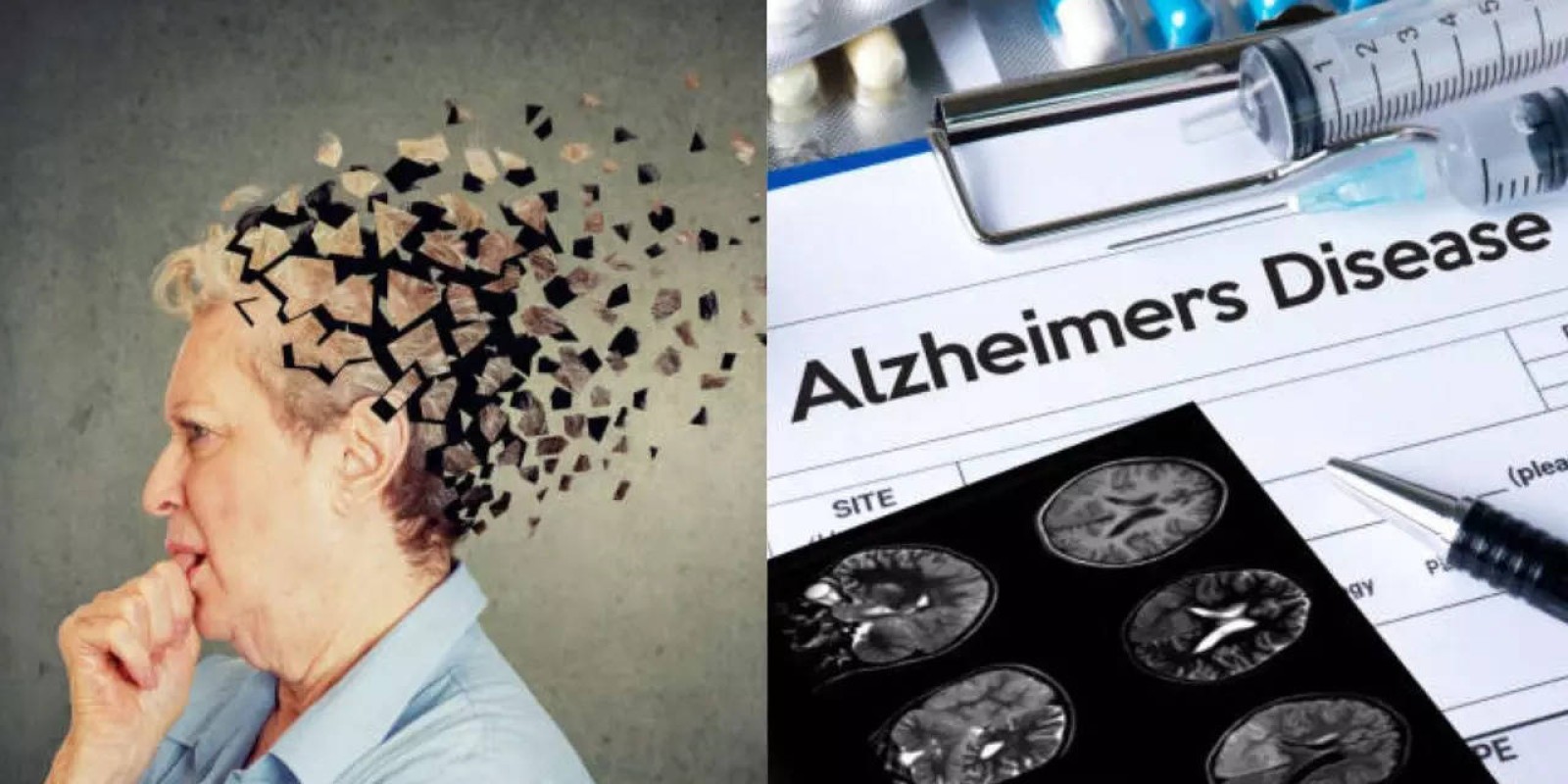 Breakthrough Research Paves the Way For Alzheimer’s Reversal Treatment; Here's How