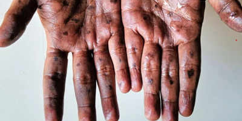 France confirms first case of more severe Clade 1b Mpox strain.