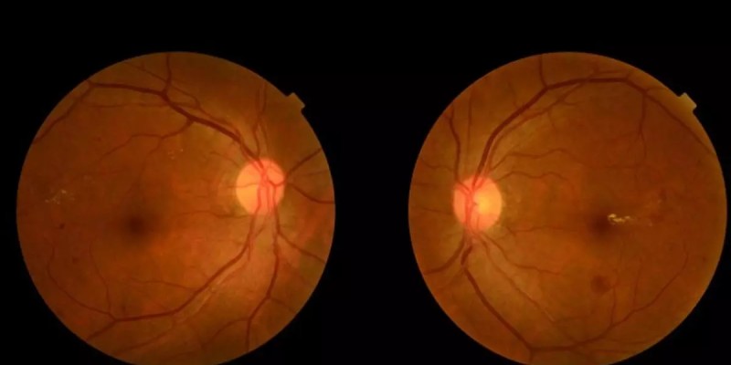 Retinal blood vessels predict stroke risk accurately, study reveals.