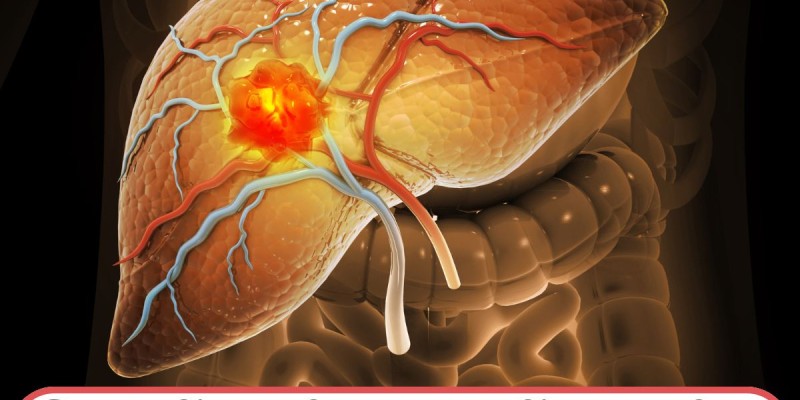 लिवर कैंसर के लिए नई इम्यूनोथेरेपी दवा, ऑपरेशन बिना ट्यूमर नियंत्रण