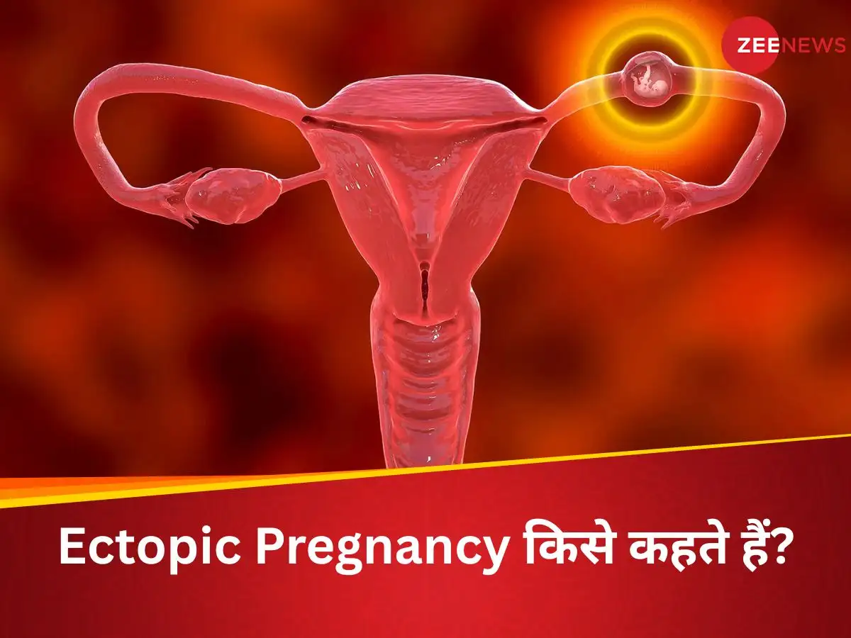एक्टोपिक प्रेगनेंसी: गलत जगह पर गर्भधारण, जानलेवा खतरा