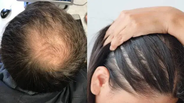 മുടി കൊഴിച്ചിൽ: കാരണങ്ങളും ചികിത്സാരീതികളും വിശദമായി