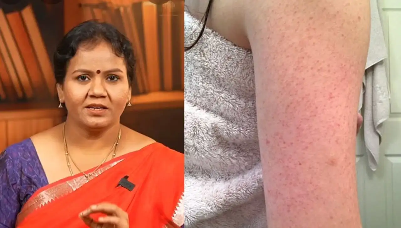 கருந்திட்டுகள் மறைக்க மஞ்சள், பால், குப்பைமேனி பயன்பாடு: டாக்டர் ஜெயரூபா வழிமுறை