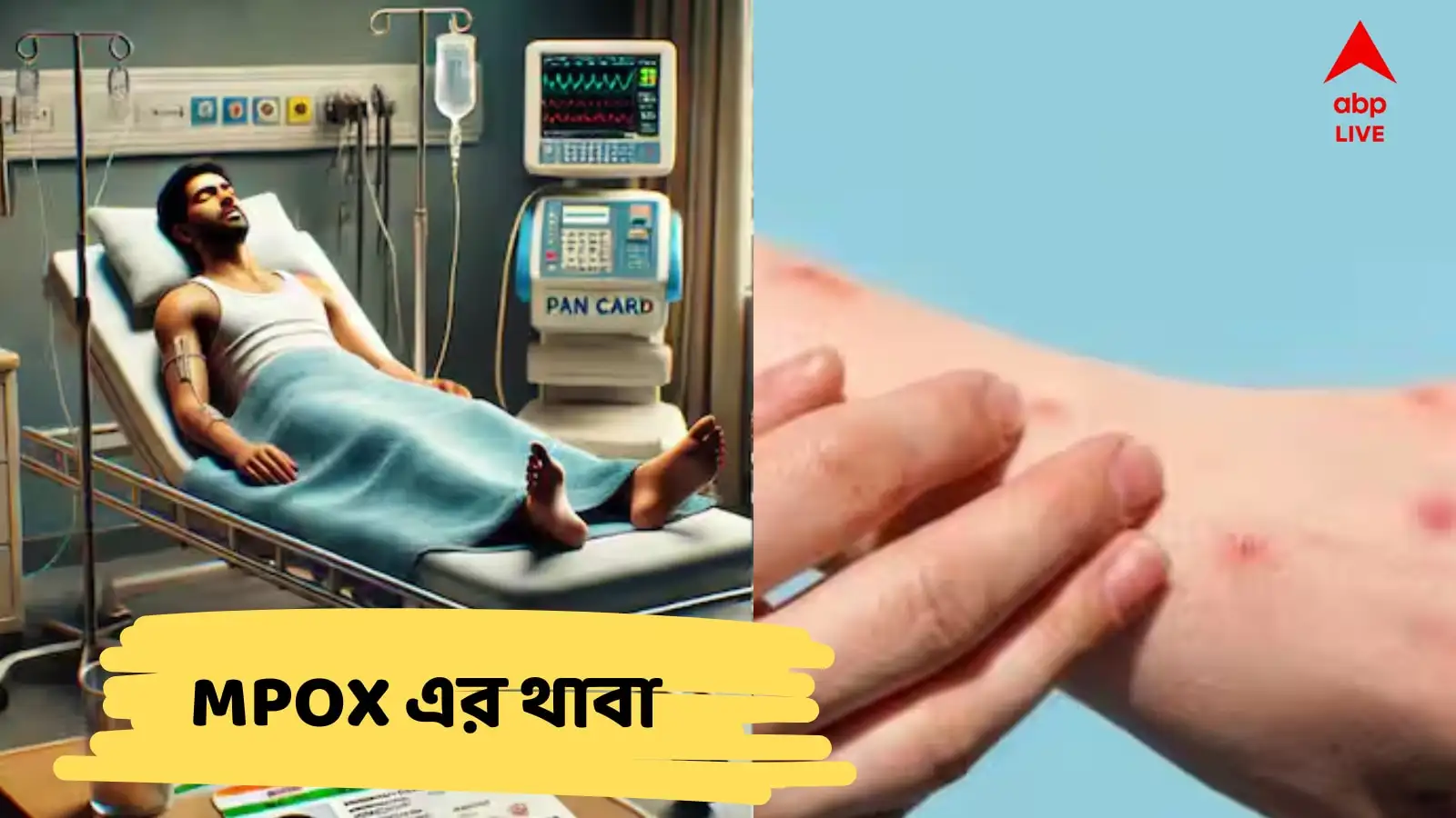 এমপক্সের প্রাদুর্ভাব:  শরীর জুড়ে ফোসকা, ব্যথা, আতঙ্ক ছড়াচ্ছে